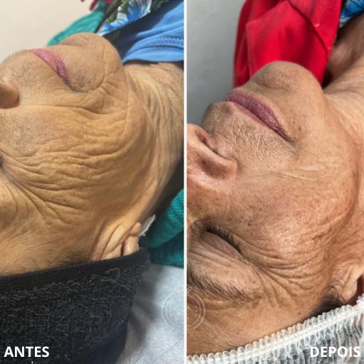 Bioestimuladores de Colágeno (2)