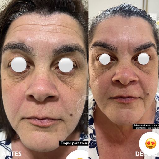 Bioestimuladores de Colágeno (4)