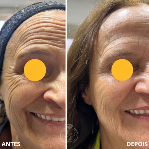 Bioestimuladores de Colágeno (5)