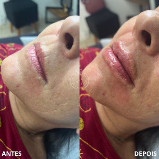 Preenchimento Labial (2)