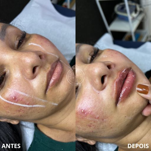 Preenchimento Labial (3)