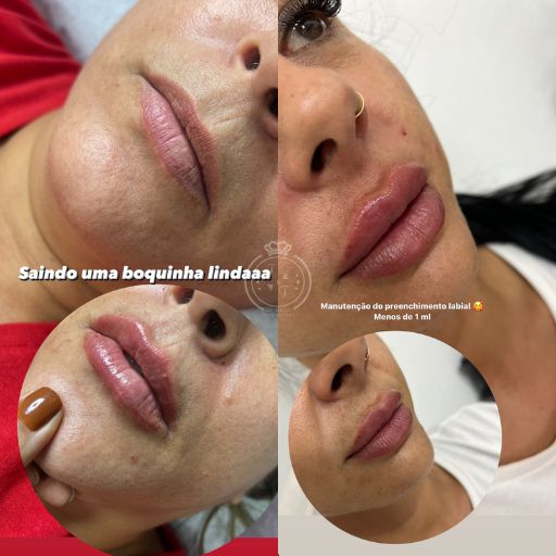 Preenchimento Labial (4)