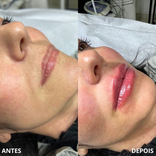 Preenchimento Labial (5)
