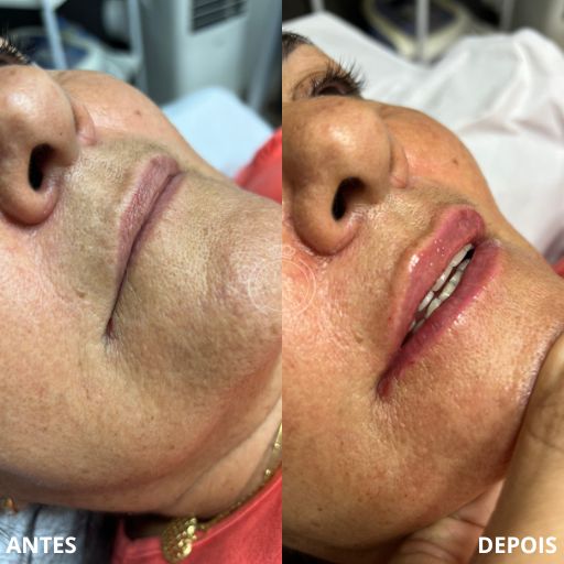 Preenchimento Labial (6)