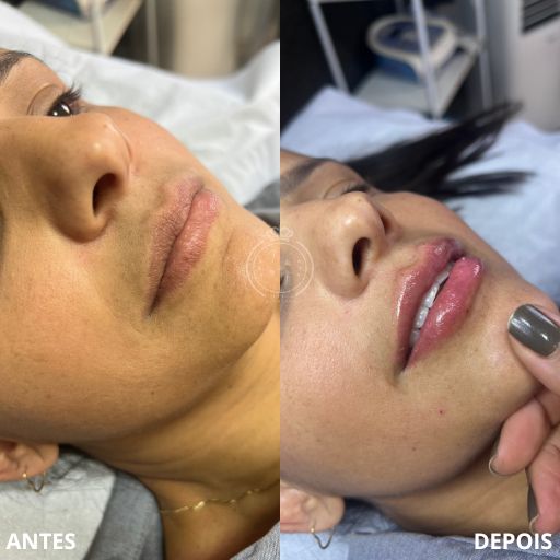 Preenchimento Labial (7)