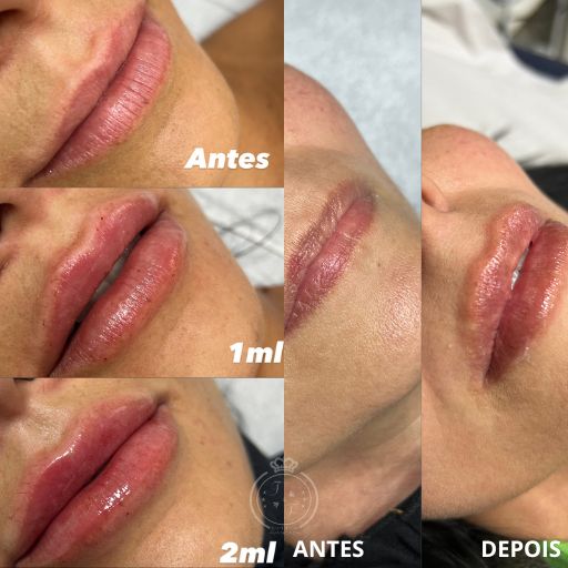 Preenchimento Labial (8)