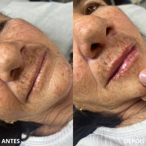 Preenchimento Labial