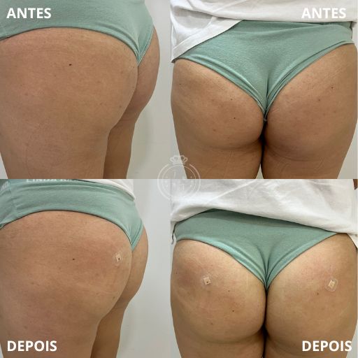 Preenchimento de Glúteo (2)