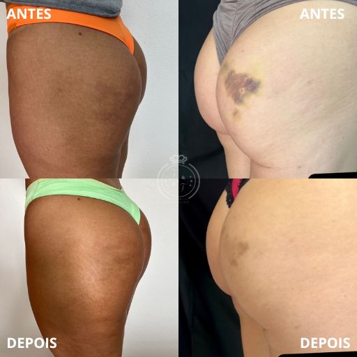 Preenchimento de Glúteo (3)