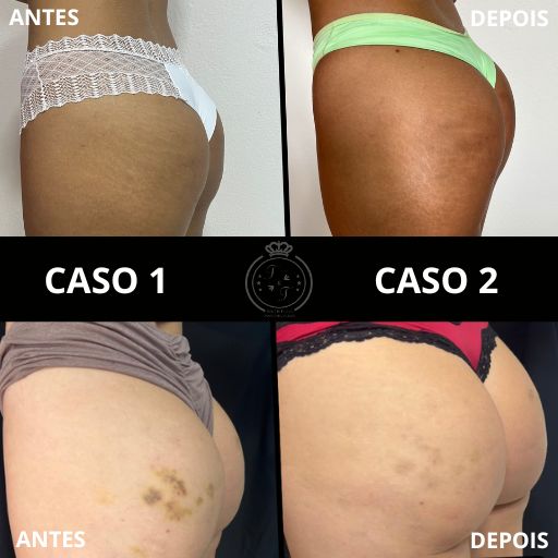 Preenchimento de Glúteo