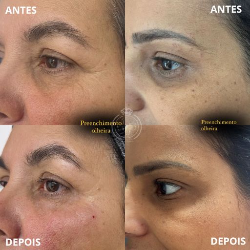 Preenchimento de Olheiras (2)