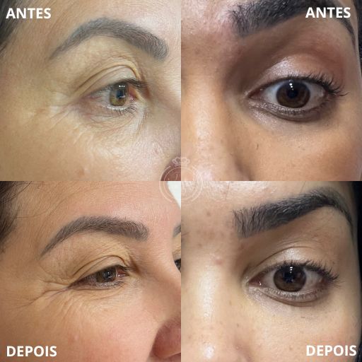 Preenchimento de Olheiras