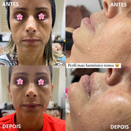 Preenchimento do Mento (2)