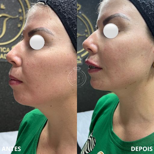 Preenchimento do Mento (3)