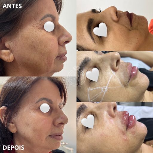 Preenchimento do Mento